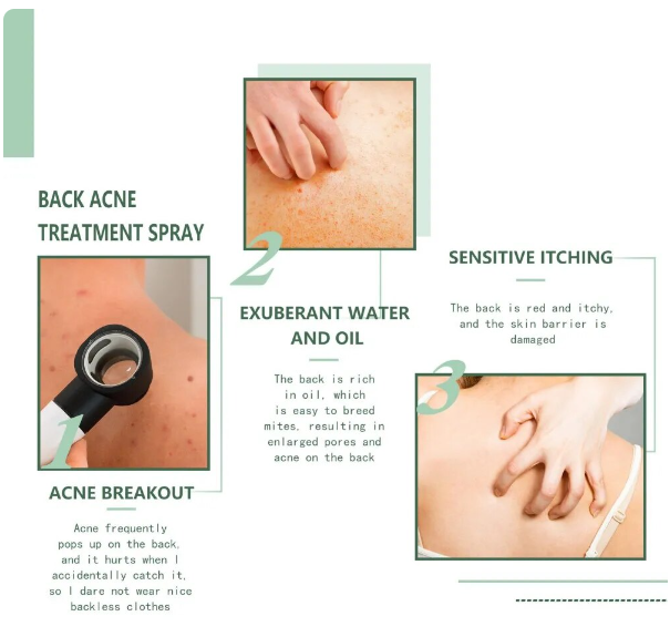Back Acne Treatment Spray