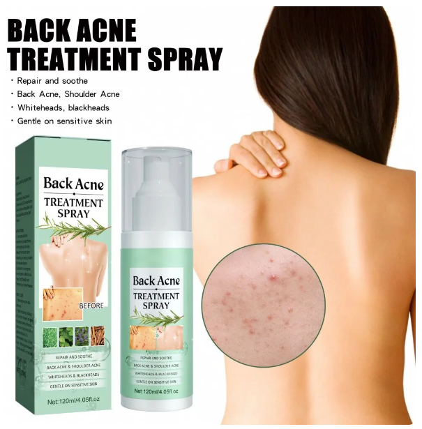 Back Acne Treatment Spray