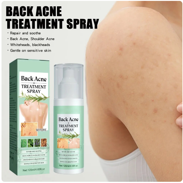 Back Acne Treatment Spray