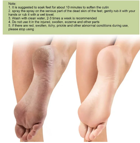 Foot Callus Removal Spray