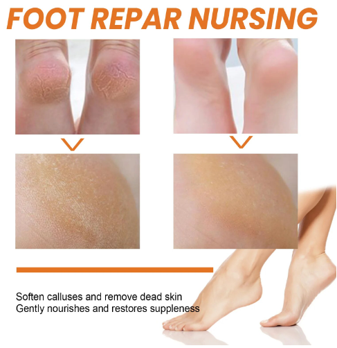 Foot Callus Removal Spray