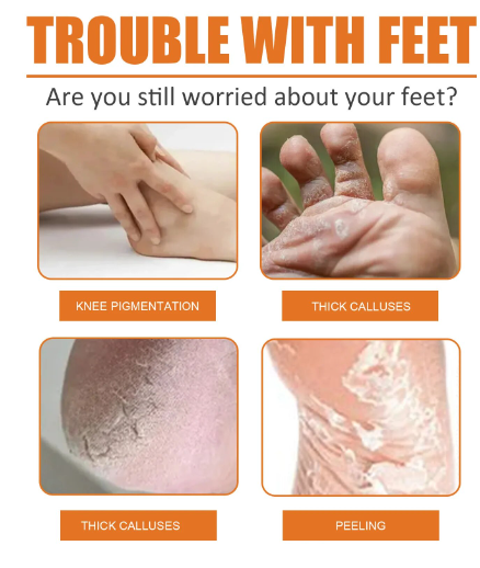 Foot Callus Removal Spray