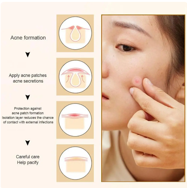Acne Pimple Patch
