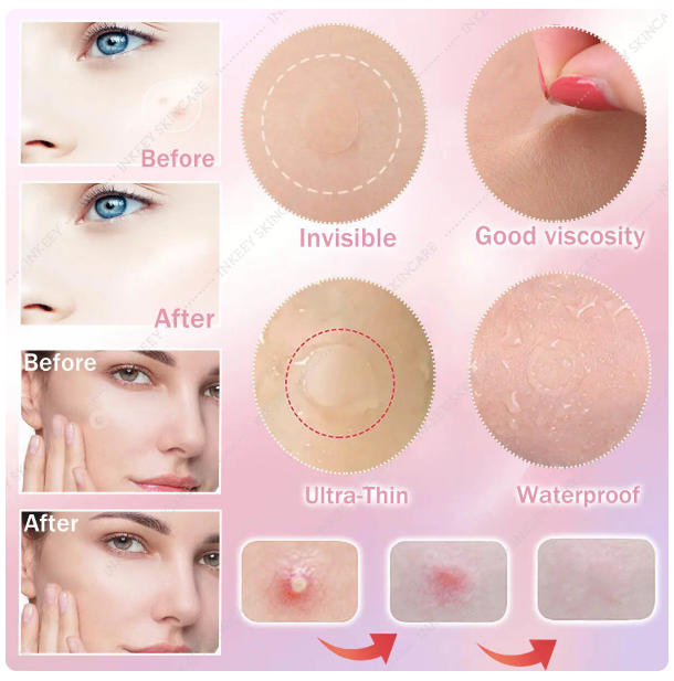 Acne Pimple Patch