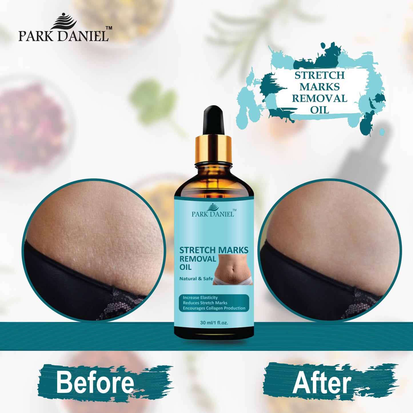 Premium Stretch Marks Removal Oil