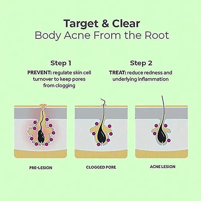 Back Acne Treatment Spray