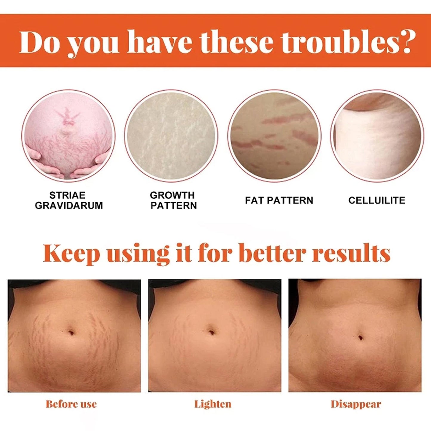 Pregnancy Stretch Marks Removal Oil